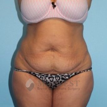 A front view before photo of patient 440 that underwent Abdominoplasty Tummy Tuck procedures at Midwest Breast & Aesthetic Surgery
