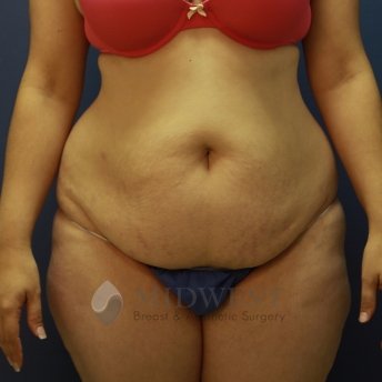 A front view before photo of patient 438 that underwent Abdominoplasty Tummy Tuck procedures at Midwest Breast & Aesthetic Surgery
