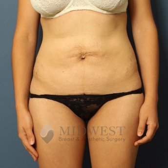 A front view before photo of patient 439 that underwent Abdominoplasty Tummy Tuck procedures at Midwest Breast & Aesthetic Surgery