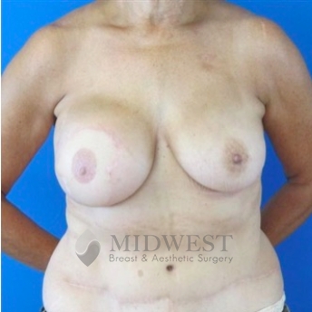 A front view after photo of patient 210 that underwent DIEP Flap Surgery procedures at Midwest Breast & Aesthetic Surgery