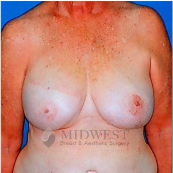 A front view after photo of patient 200 that underwent DIEP Flap Surgery procedures at Midwest Breast & Aesthetic Surgery