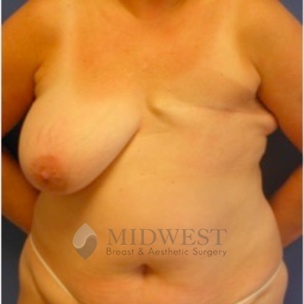 A front view before photo of patient 233 that underwent DIEP Flap Surgery procedures at Midwest Breast & Aesthetic Surgery