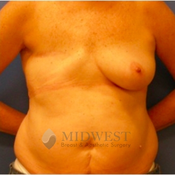 A front view before photo of patient 209 that underwent DIEP Flap Surgery procedures at Midwest Breast & Aesthetic Surgery