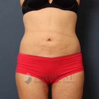 A front view after photo of patient 259 that underwent Liposuction procedures at Midwest Breast & Aesthetic Surgery