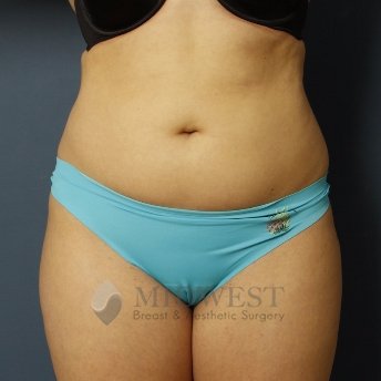 A front view before photo of patient 261 that underwent Liposuction procedures at Midwest Breast & Aesthetic Surgery