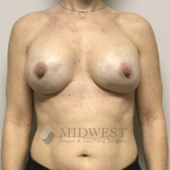 A front view after photo of patient 516 that underwent Tissue Expander Implant Based procedures at Midwest Breast & Aesthetic Surgery