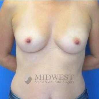 A front view before photo of patient 243 that underwent Tissue Expander Implant Based procedures at Midwest Breast & Aesthetic Surgery